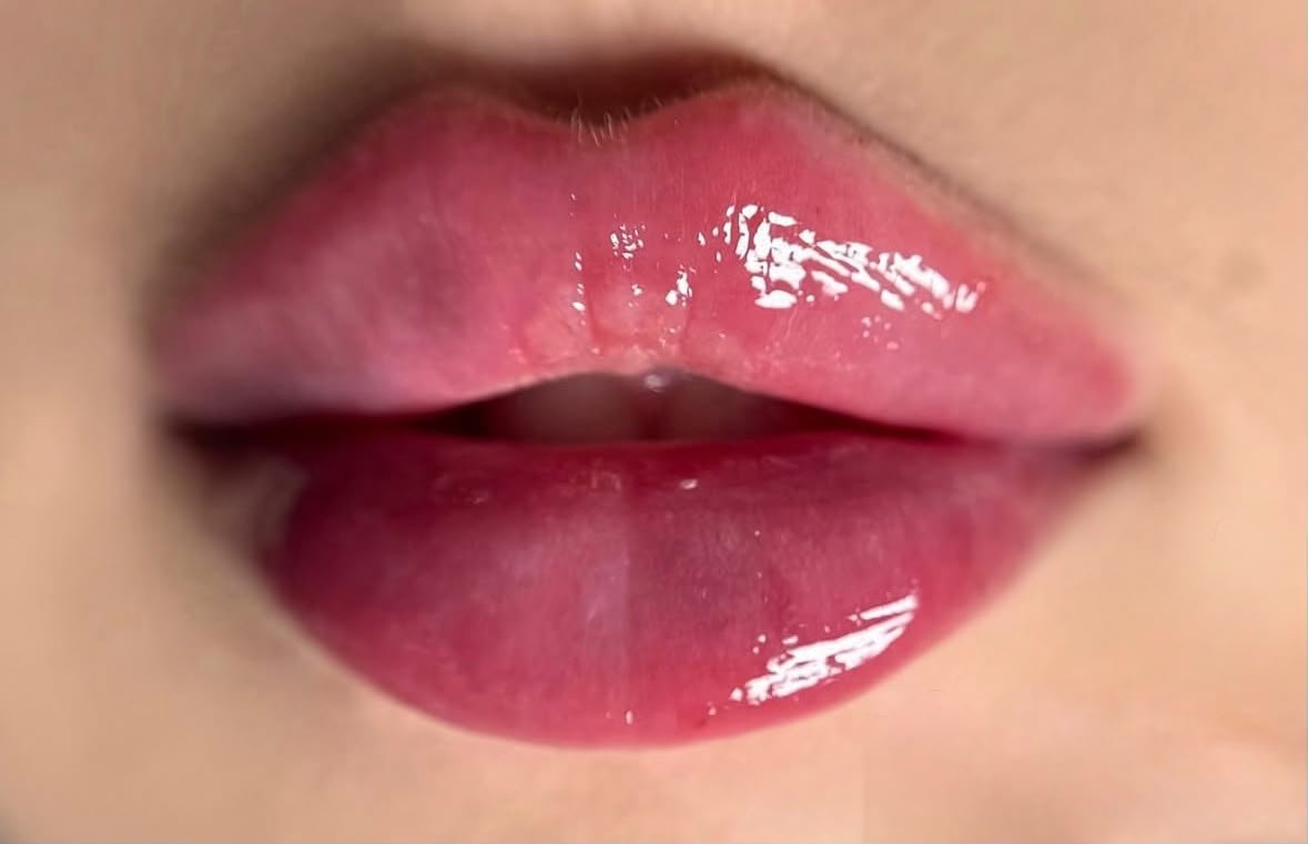 Close-up of lips after a filler treatment