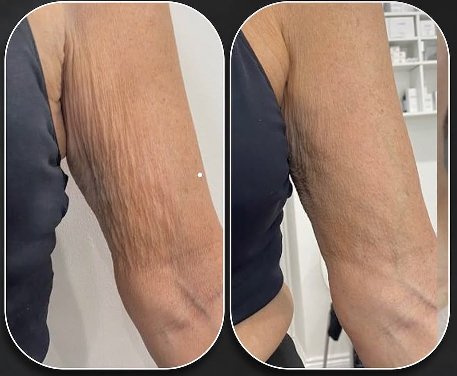 Before and after upper-arm skin appearance following HIFU treatment