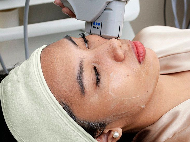 HIFU facial treatment with a handheld device