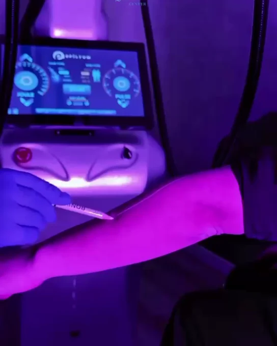 Epilyum laser