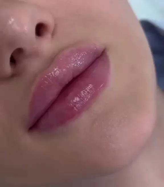 Lip filler result