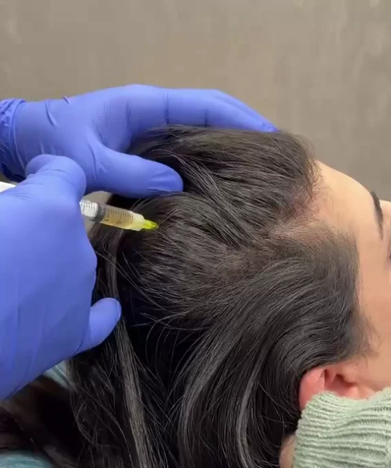 PRP hair treatment